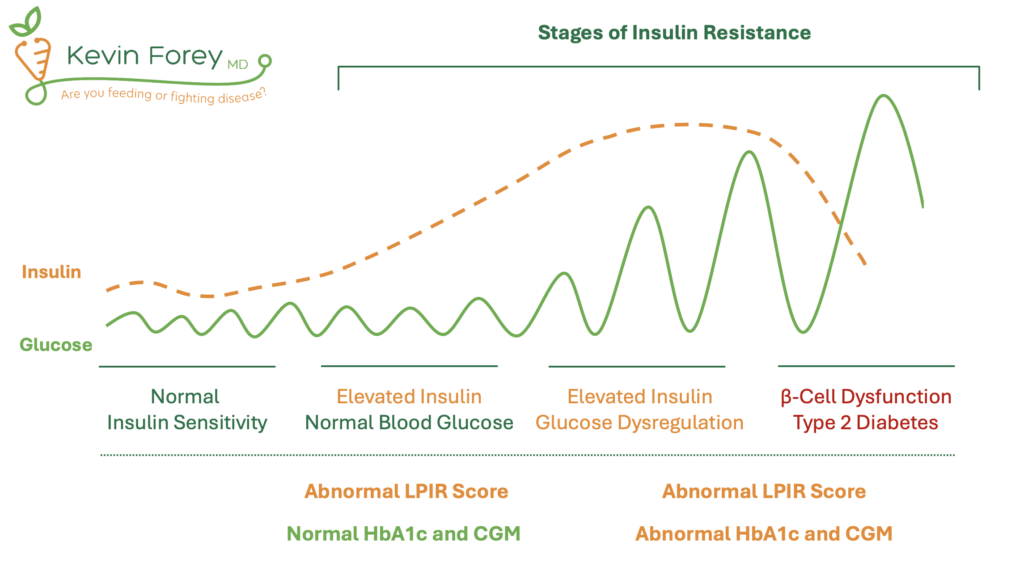 A graphic illustration of the stages of Insulin Resistance, where Glucose and Insulin are depicted as lines along the spectrum of Insulin Resistance, including low levels of Glucose and Insulin during stages of Normal Insulin sensitivity, elevated Insulin but normal Glucose during early stages of Insulin Resistance, elevated Glucose and Insulin at stages of Insulin Resistance and Diabetes, and eventually a decrease in Insulin but further increase in Glucose due to pancreatic Beta-cell dysfunction in advanced Diabetes